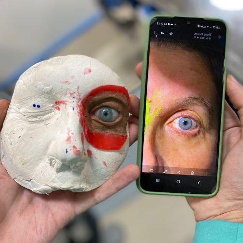 Prótese Bucomaxilo em Porto Alegre Bucomaxilofacial implantes prótese bucomaxilofacial odontologia hospitalar em porto alegre buco1 (1)