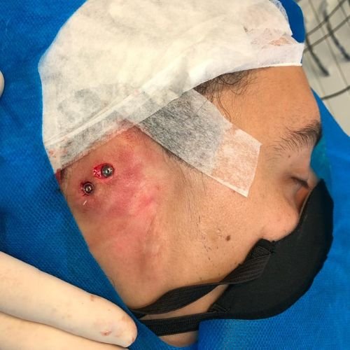 Bucomaxilofacial implantes prótese bucomaxilofacial odontologia hospitalar em porto alegre buco4 (1)