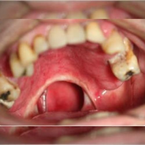 Bucomaxilofacial implantes prótese bucomaxilofacial odontologia hospitalar em porto alegre buco4 (2)46