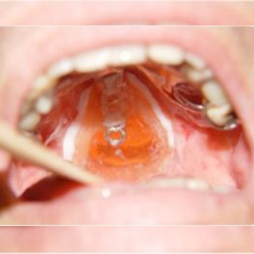 Bucomaxilofacial implantes prótese bucomaxilofacial odontologia hospitalar em porto alegre buco4 (3)46