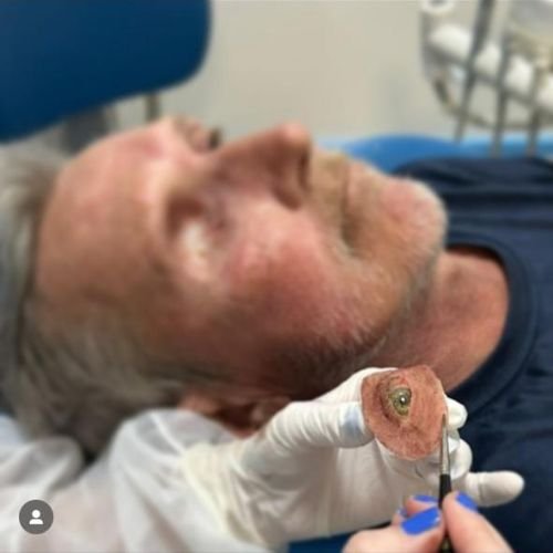 Bucomaxilofacial implantes prótese bucomaxilofacial odontologia hospitalar em porto alegre buco4 (5)46
