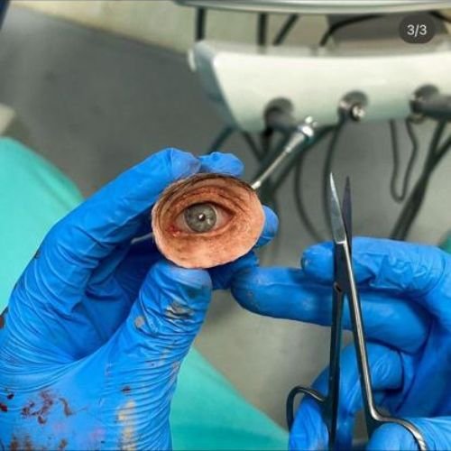 Bucomaxilofacial implantes prótese bucomaxilofacial odontologia hospitalar em porto alegre buco4 (6)46