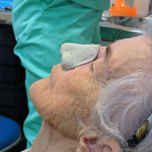 Bucomaxilofacial implantes prótese bucomaxilofacial odontologia hospitalar em porto alegre buco4 (8)466