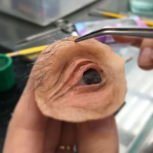 Bucomaxilofacial implantes prótese bucomaxilofacial odontologia hospitalar em porto alegre buco protese bucomaxilofacial (11)