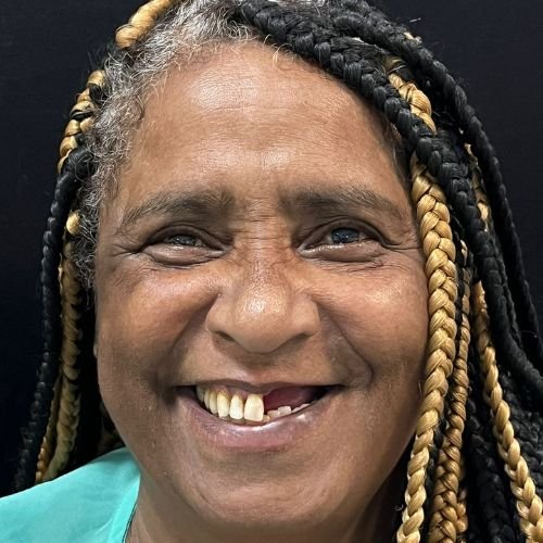 Bucomaxilofacial implantes prótese bucomaxilofacial odontologia hospitalar em porto alegre buco protese bucomaxilofacial (17)
