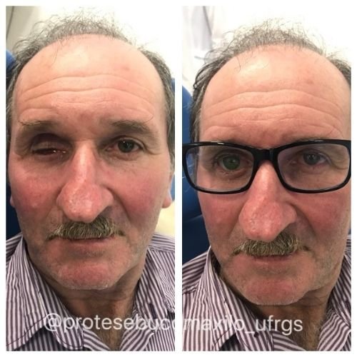 Bucomaxilofacial implantes prótese bucomaxilofacial odontologia hospitalar em porto alegre buco protese bucomaxilofacial (5)