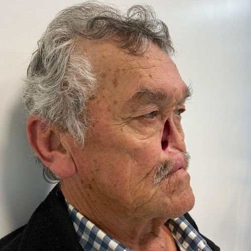 Bucomaxilofacial implantes prótese bucomaxilofacial odontologia hospitalar em porto alegre buco protese bucomaxilofacial (6)