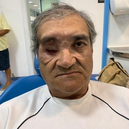 Bucomaxilofacial implantes prótese bucomaxilofacial odontologia hospitalar em porto alegre buco protese bucomaxilofacial (7)